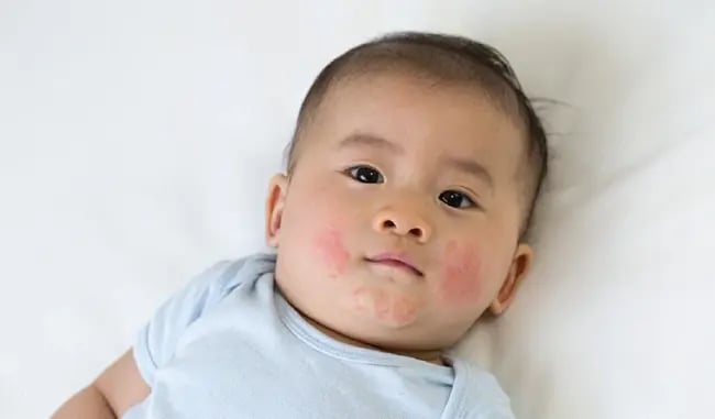My Child Had a Reaction After a Previous Vaccine — What Should I Tell the Pediatrician Before the Next Dose?