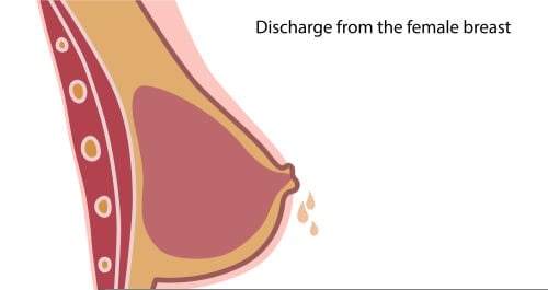 Nipple Discharge Presentations Causes and Management-1