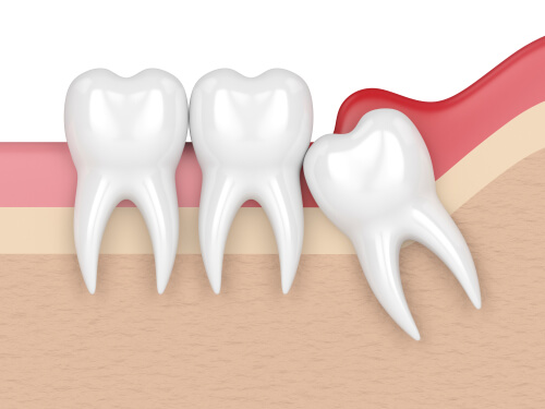 Pericoronitis in dentistry