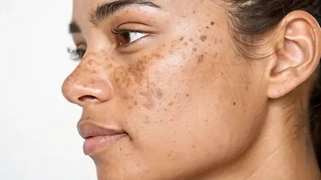 Pigmentation & Melasma in Dubai’s Climate: Advanced Solutions at DRHC Healthcare