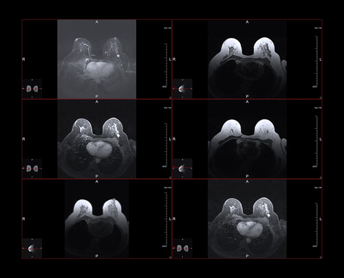 The importance of MRI scan in detection of breast cancer DRHC Dubai Breast Surgery