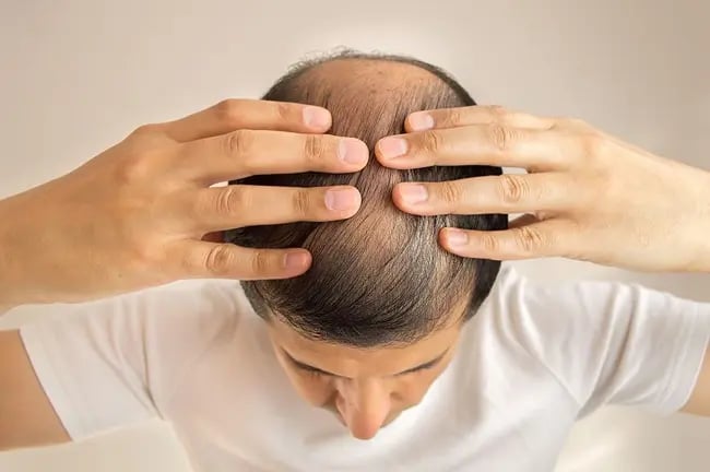 The Ultimate Guide to Hair Regrowth: From PRP to Advanced Regenerative Medicine