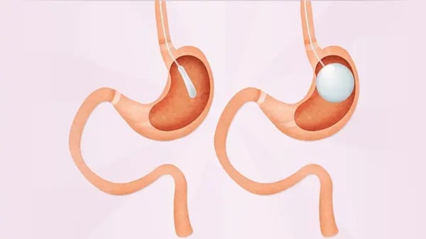 Weight-Loss-Injections-Gastric-Balloon-or-Surgery-drhc-blog-post