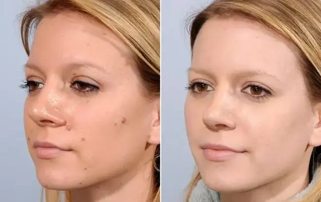What to Expect After Skin Cryotherapy Treatment