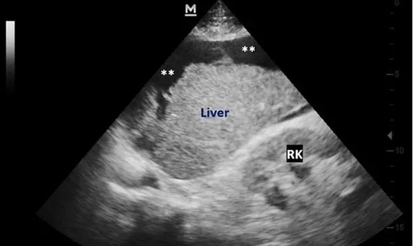 Your Ultrasound Shows Fatty Liver—What Happens Next?