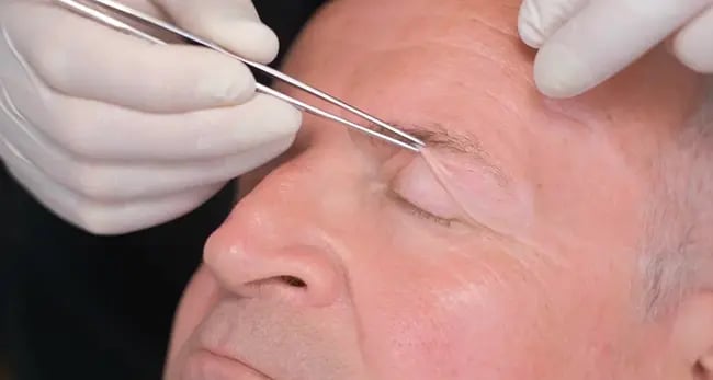 BlepharoplastY