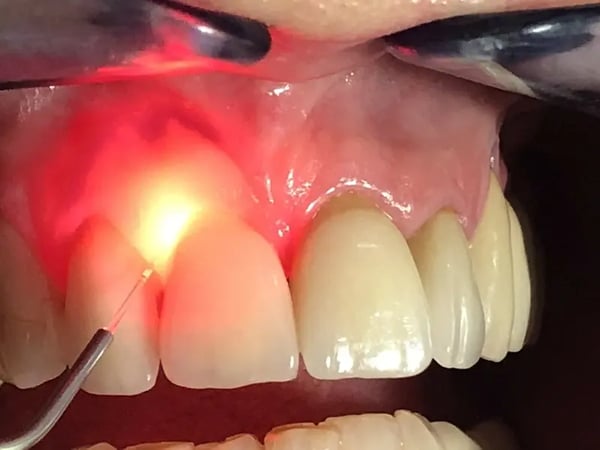 Say Goodbye to Dark Gums: The Ultimate Guide to Laser Gum Depigmentation