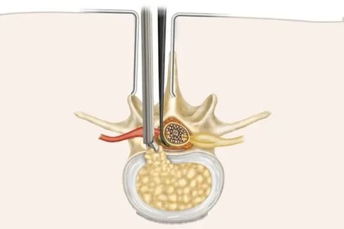 Is Endoscopic Spinal Discectomy a High-Risk Surgery?