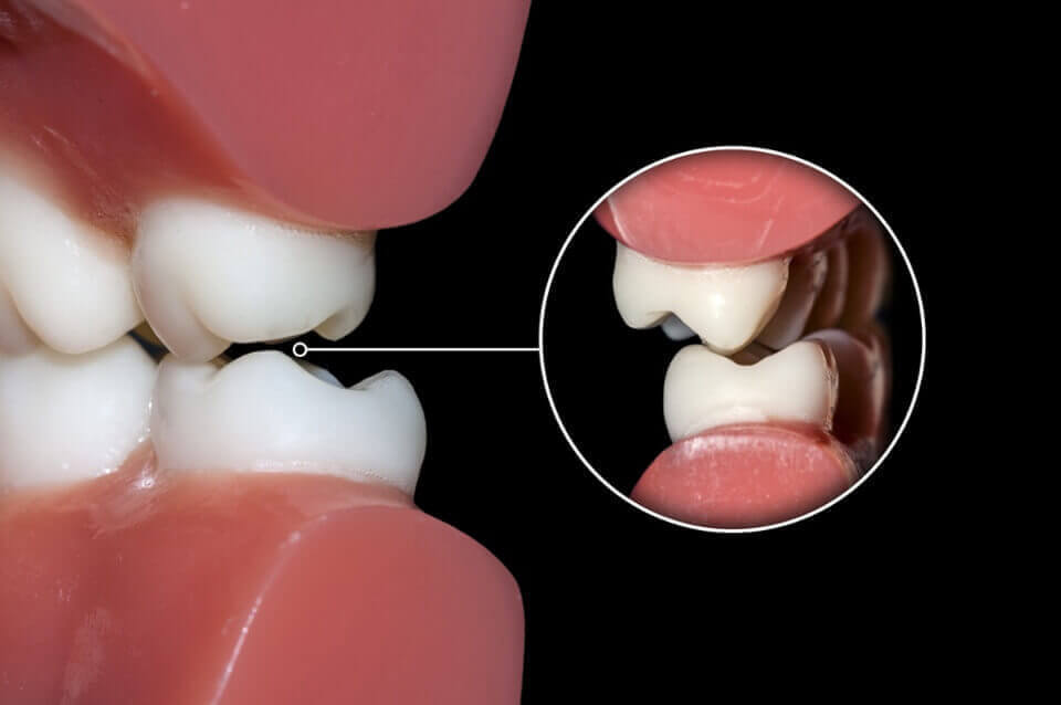 Teeth Grinding and Gum Recession