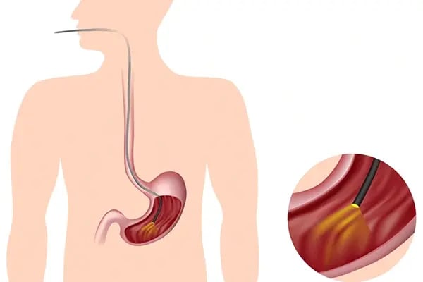 gastroscopy-drhc-blog-post