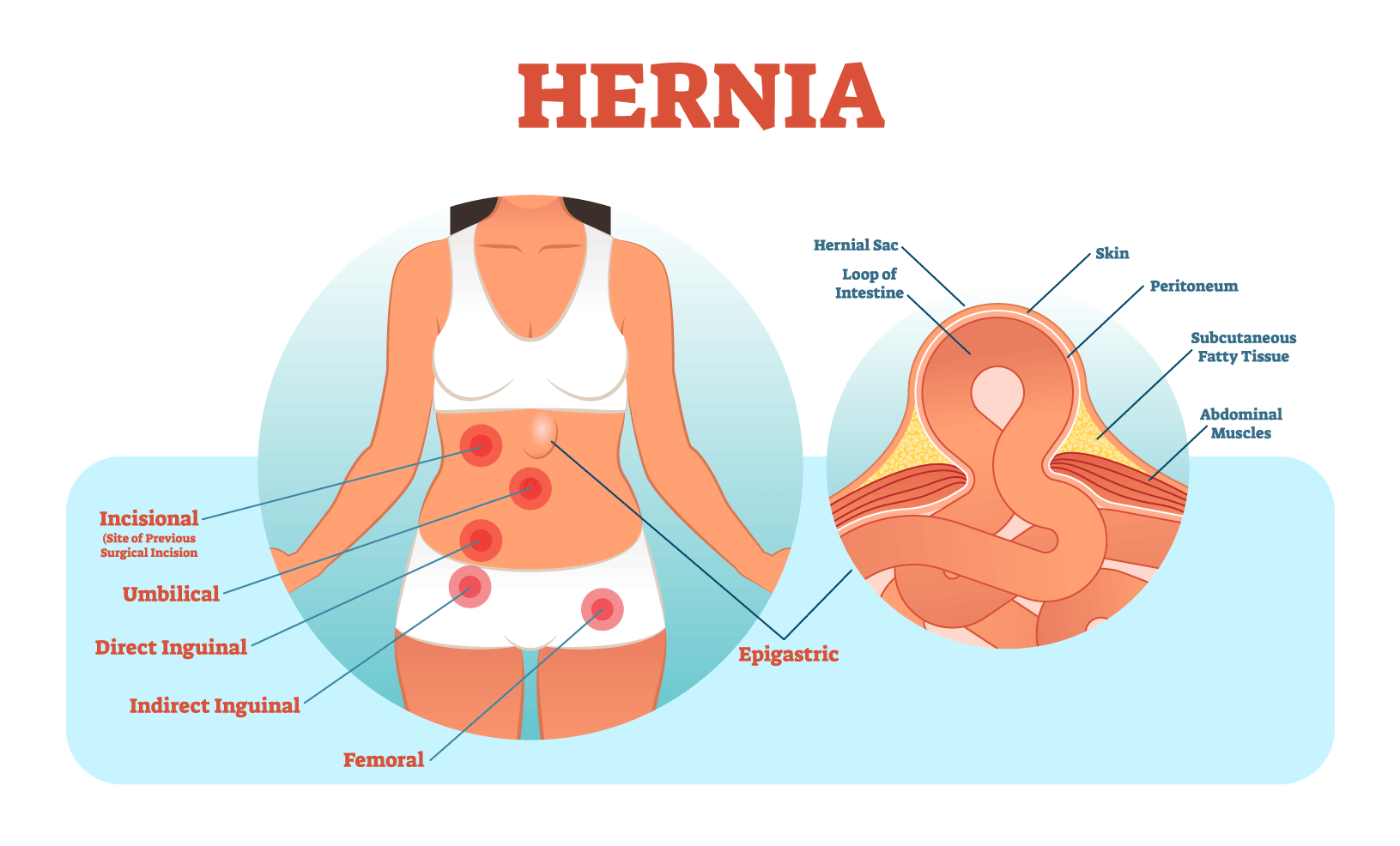 hernia-types-[Converted]-1