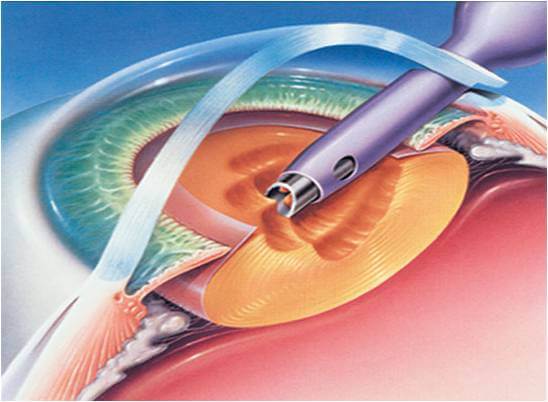 5 Reasons to Not Delay Cataract Surgery Any Longer