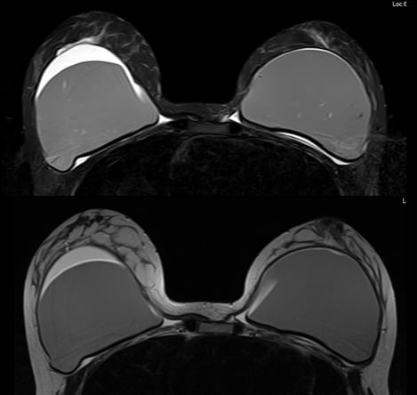 mri_breast_slide