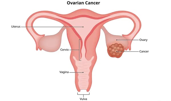 Ovarian Cancer