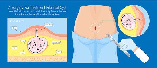 Pilonidal Sinus