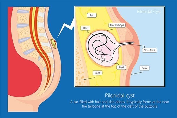 Pilonidal Sinus