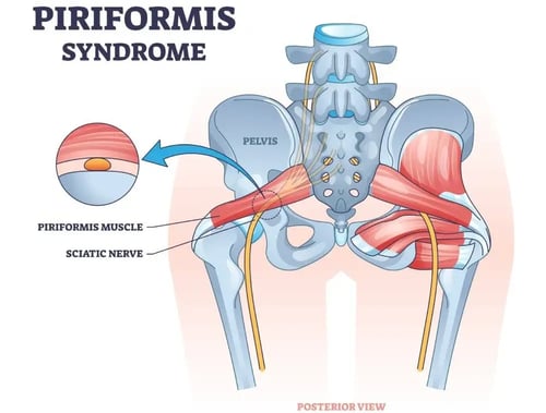 Piriformis Syndrome