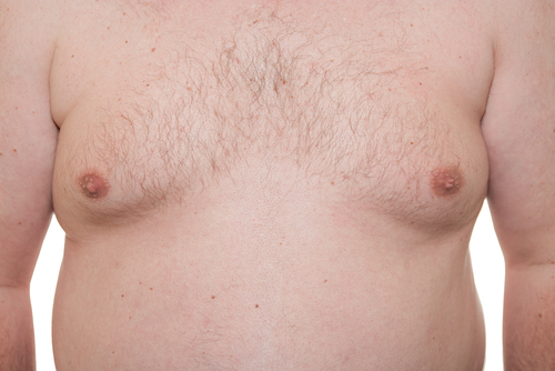 Gynaecomastia (Male breasts, Man boobs): Causes and Treatment