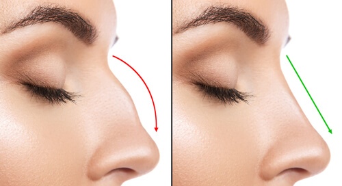 Nose job Function versus shape