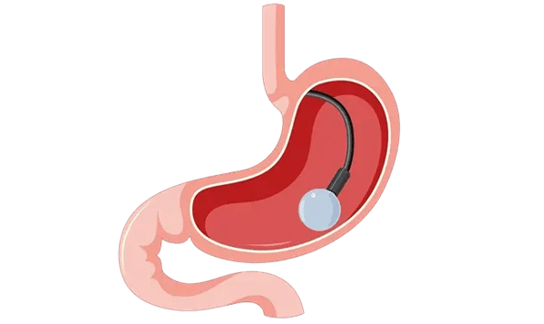 Swallowable Gastric Balloon vs Endoscopic Gastric Balloon: What Is the Difference?