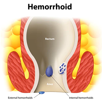 Main_Cause_of_hemorrhoids