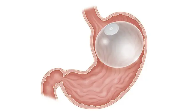 Am I a Good Candidate for a Gastric Balloon?