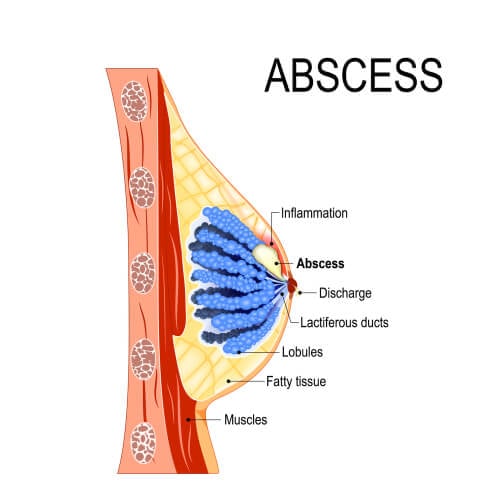 Breast Abscess