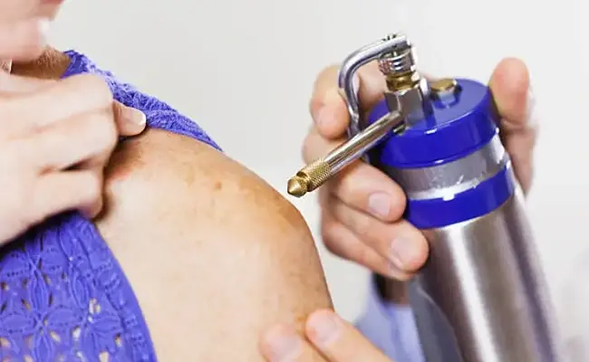 Can Cryotherapy Remove Skin Tags and Warts Permanently?