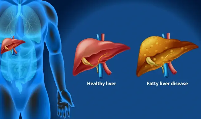 Can Fatty Liver Be Reversed? What Improvement Looks Like