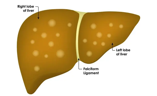 Can Fatty Liver Return After It Improves?
