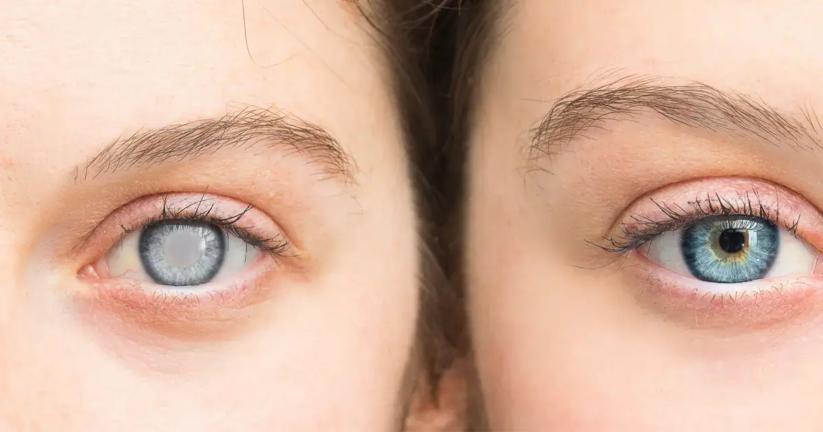 When Eye Drops and Glasses Stop Working: Why Cataract Surgery Becomes Necessary