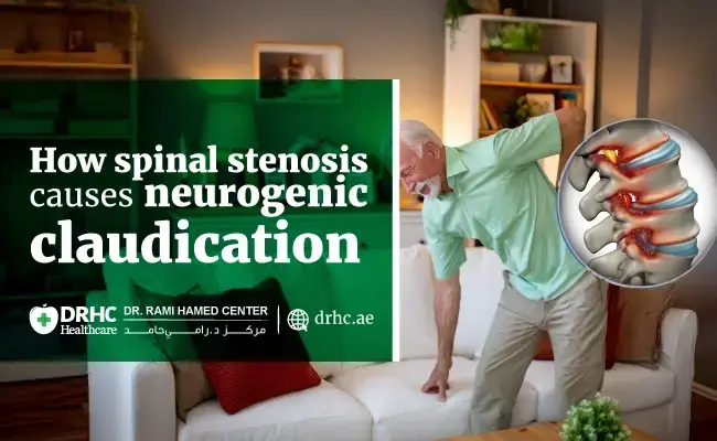How spinal stenosis causes neurogenic claudication