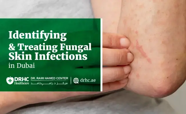 Identifying & Treating Fungal Skin Infections in Dubai