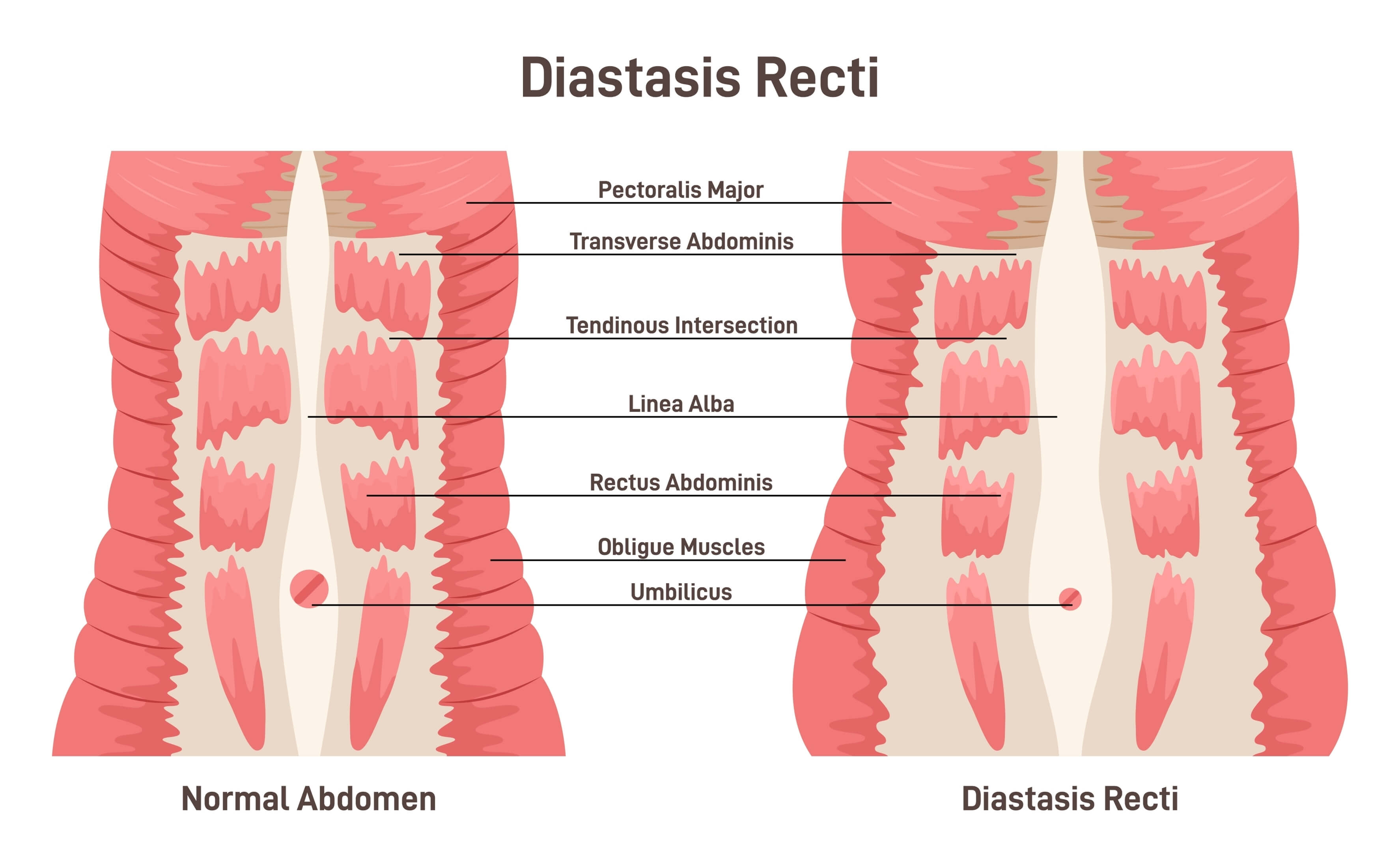 Abdominal Muscle separation: Diastasis Rectus Abdominal Muscle (DRAM)