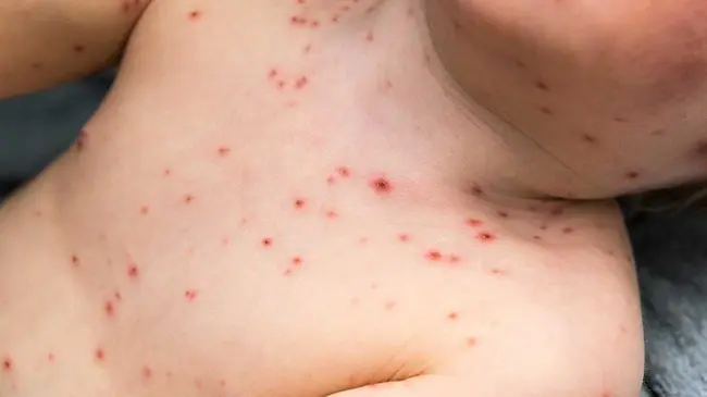 Does the Chickenpox Vaccine Mean My Child Will Never Get Chickenpox?