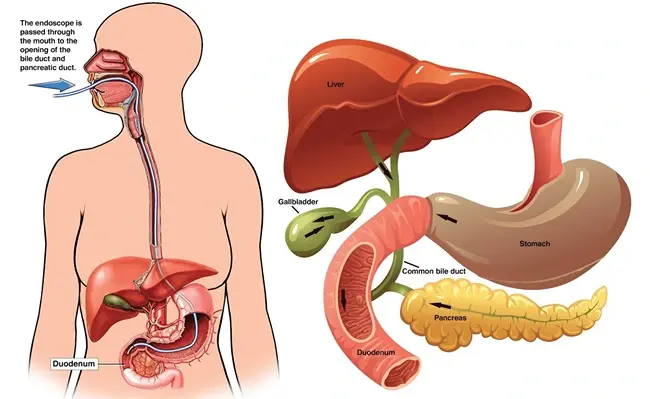 ERCP: When Is It Needed for Bile Duct or Pancreatic Problems?