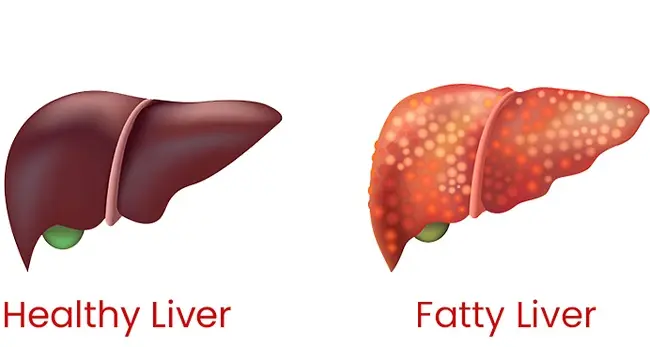 Enlarged Liver vs Fatty Liver: Are They the Same?
