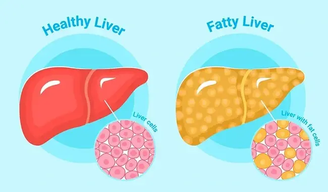 Fatty Liver Grade vs Fibrosis Stage: What Is the Difference?