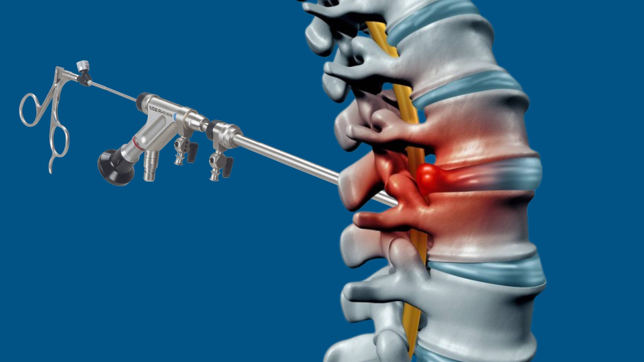 How risky is endoscopic discectomy?