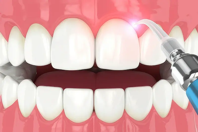 Gummy Smile Treatment: How Laser Reshapes Your Gums for a Perfect Smile