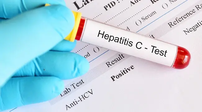 Hepatitis C Positive Result: What Further Tests Are Needed?