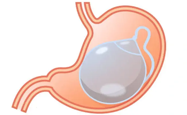 How Long Does a Gastric Balloon Stay in the Stomach?