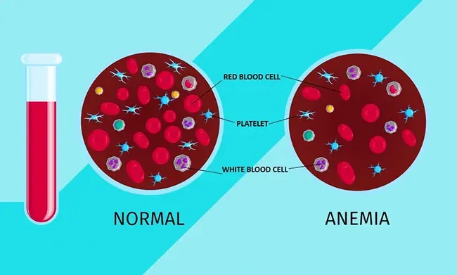 Iron-Deficiency Anaemia: When Are Gastroscopy and Colonoscopy Recommended?