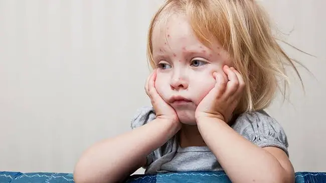 My Child Already Had Chickenpox — Do They Still Need the Vaccine?