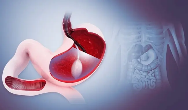 What Happens After a Gastric Balloon Is Removed?