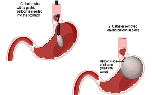 What Happens During a Gastric Balloon Procedure?