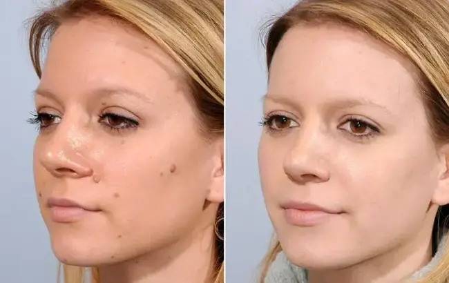 What to Expect After Skin Cryotherapy Treatment