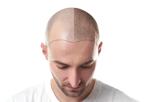 Why choose DRHC for your hair transplant?