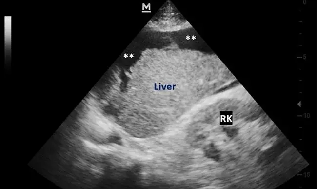 Your Ultrasound Shows Fatty Liver—What Happens Next?