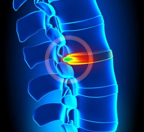 6 Possible complications after Lumbar Discectomy